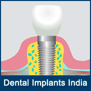 Laser Root Canal Treatment Cost in India